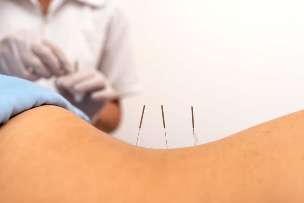 Close up of dry needling