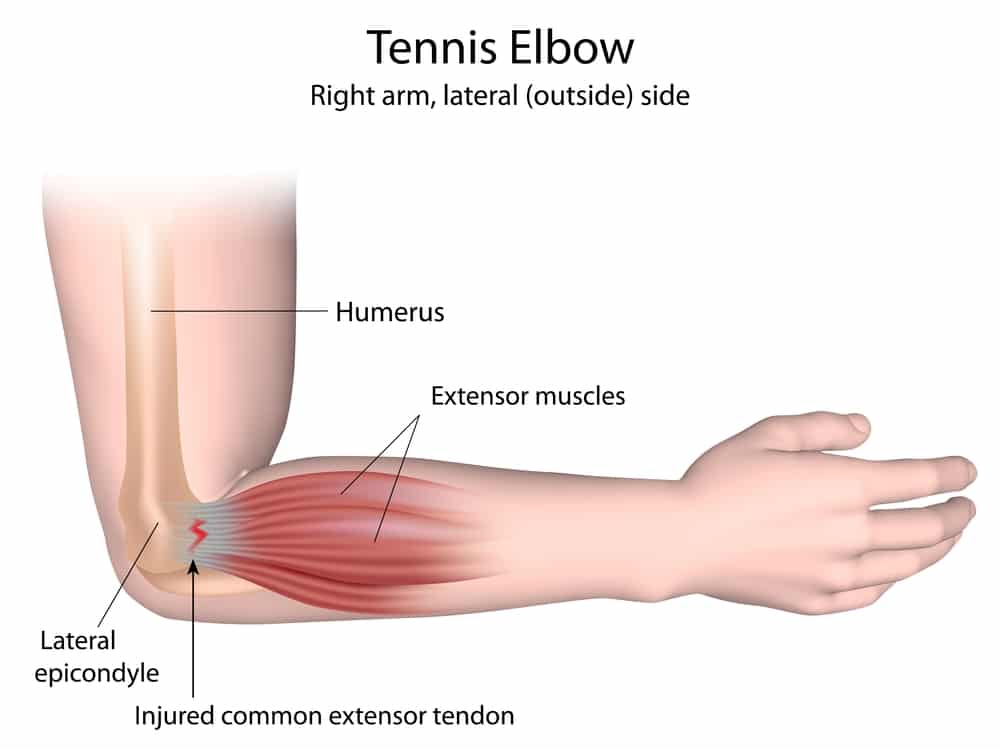 Diagram of tennis elbow